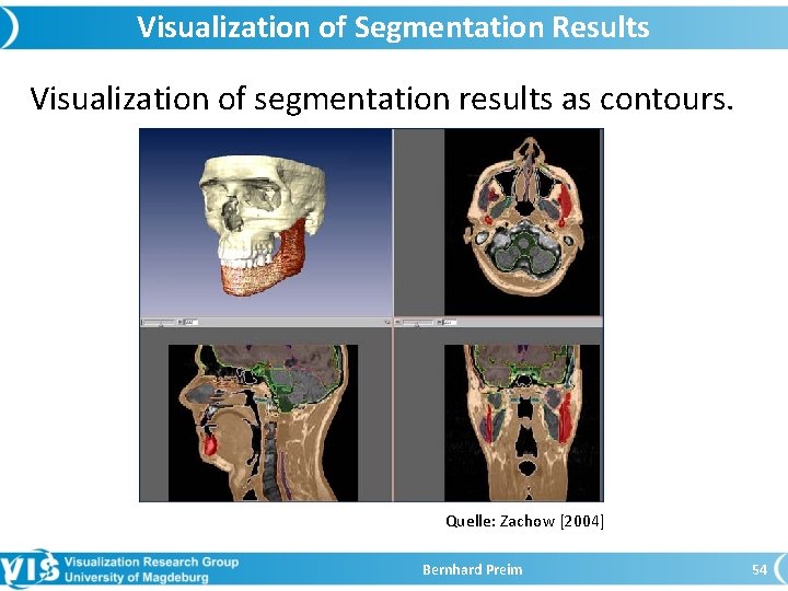 Visualization of Segmentation Results Visualization of segmentation results as contours. Quelle: Zachow [2004] Bernhard