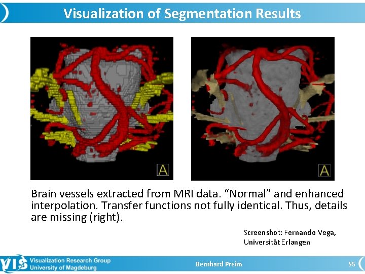 Visualization of Segmentation Results Brain vessels extracted from MRI data. “Normal” and enhanced interpolation.