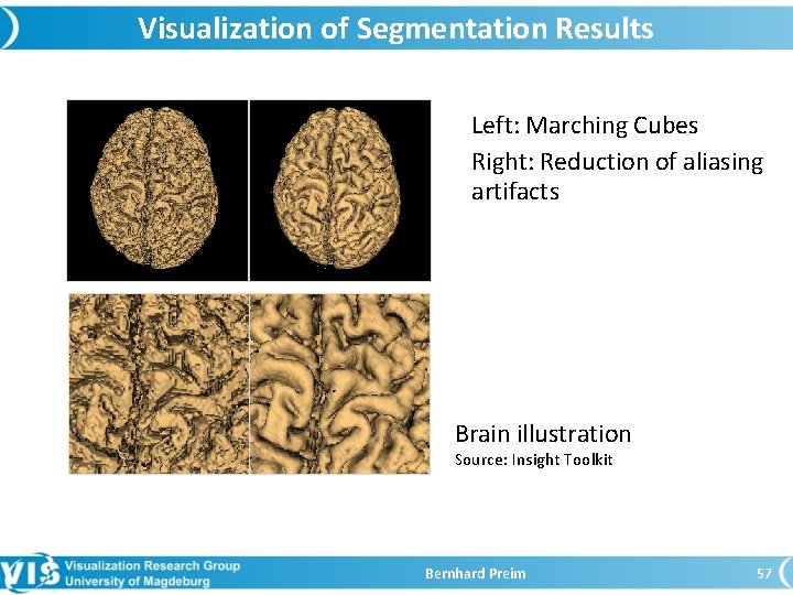 Visualization of Segmentation Results Left: Marching Cubes Right: Reduction of aliasing artifacts Brain illustration