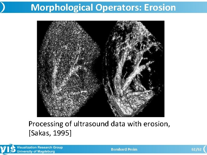 Morphological Operators: Erosion Processing of ultrasound data with erosion, [Sakas, 1995] Bernhard Preim 62/62