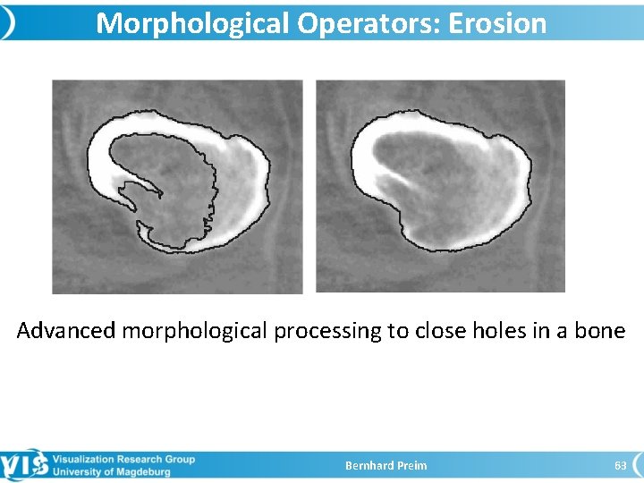 Morphological Operators: Erosion Advanced morphological processing to close holes in a bone Bernhard Preim