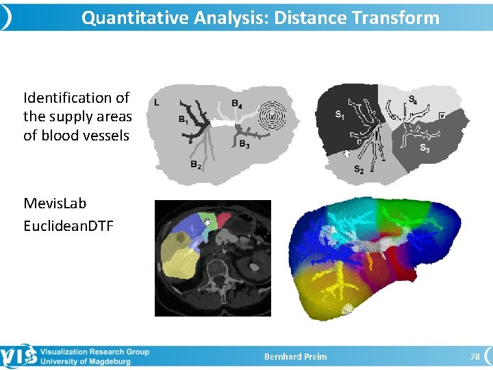 Quantitative Analysis: Distance Transform Identification of the supply areas of blood vessels Mevis. Lab