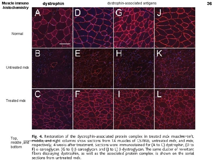Muscle immuno -histochemistry Normal Untreated mdx Top, middle , and bottom dystrophin-associated antigens 36