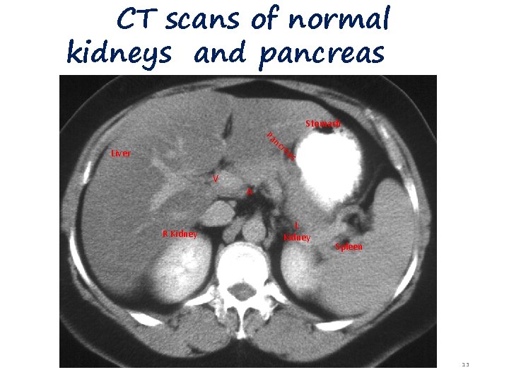 CT scans of normal kidneys and pancreas Pa nc r Stomach ea s Liver