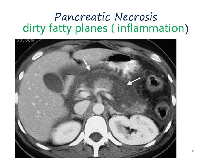 Pancreatic Necrosis dirty fatty planes ( inflammation) 14 