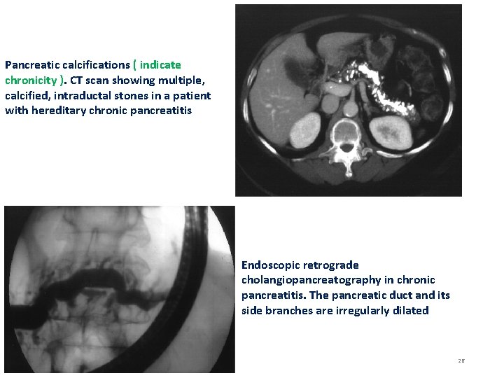 Pancreatic calcifications ( indicate chronicity ). CT scan showing multiple, calcified, intraductal stones in