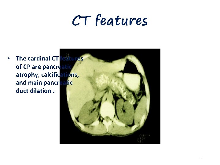 CT features • The cardinal CT features of CP are pancreatic atrophy, calcifications, and