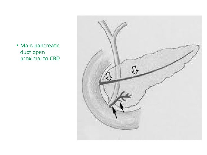  • Main pancreatic duct open proximal to CBD 