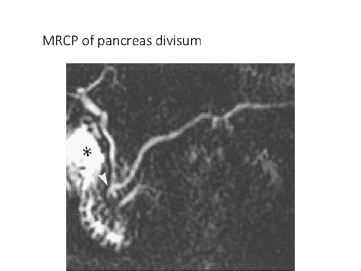 MRCP of pancreas divisum 