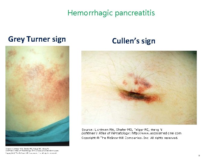 Hemorrhagic pancreatitis Grey Turner sign Cullen’s sign 9 