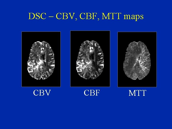 DSC – CBV, CBF, MTT maps CBV CBF MTT 