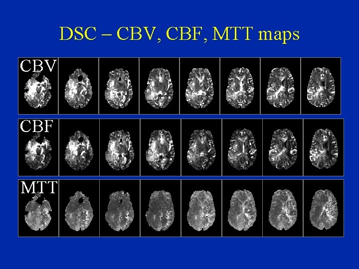 DSC – CBV, CBF, MTT maps CBV CBF MTT 
