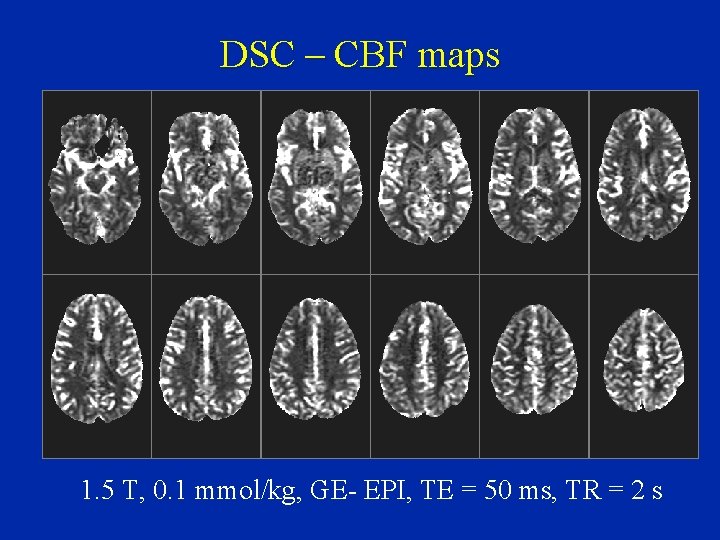 DSC – CBF maps 1. 5 T, 0. 1 mmol/kg, GE- EPI, TE =