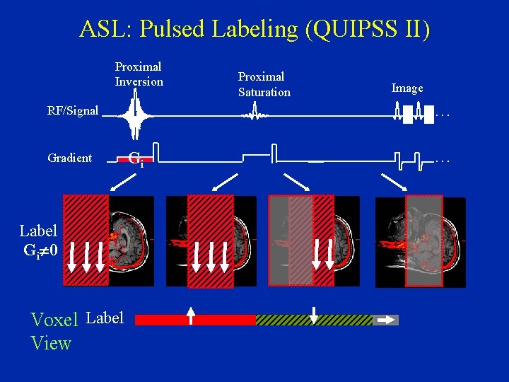 ASL: Pulsed Labeling (QUIPSS II) Proximal Inversion Label Gi¹ 0 Voxel Label View Image