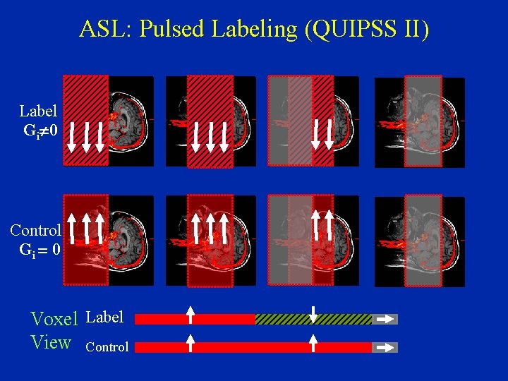 ASL: Pulsed Labeling (QUIPSS II) Label Gi¹ 0 Control Gi = 0 Voxel Label
