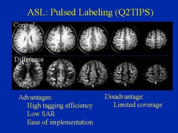 ASL: Pulsed Labeling (Q 2 TIPS) Control Difference Advantages: High tagging efficiency Low SAR