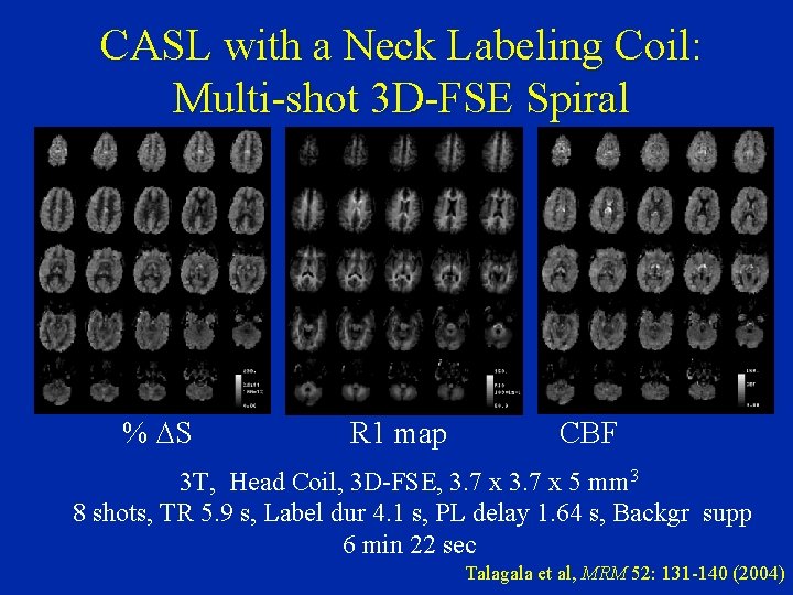 CASL with a Neck Labeling Coil: Multi-shot 3 D-FSE Spiral % DS R 1