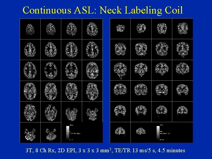 Continuous ASL: Neck Labeling Coil 3 T, 8 Ch Rx, 2 D EPI, 3