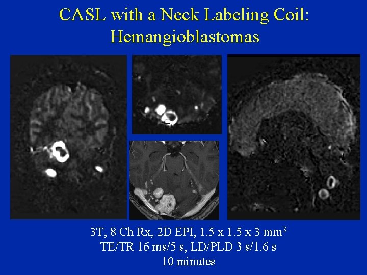 CASL with a Neck Labeling Coil: Hemangioblastomas 3 T, 8 Ch Rx, 2 D