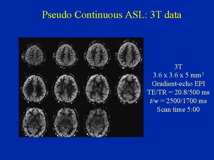 Pseudo Continuous ASL: 3 T data 3 T 3. 6 x 5 mm 3