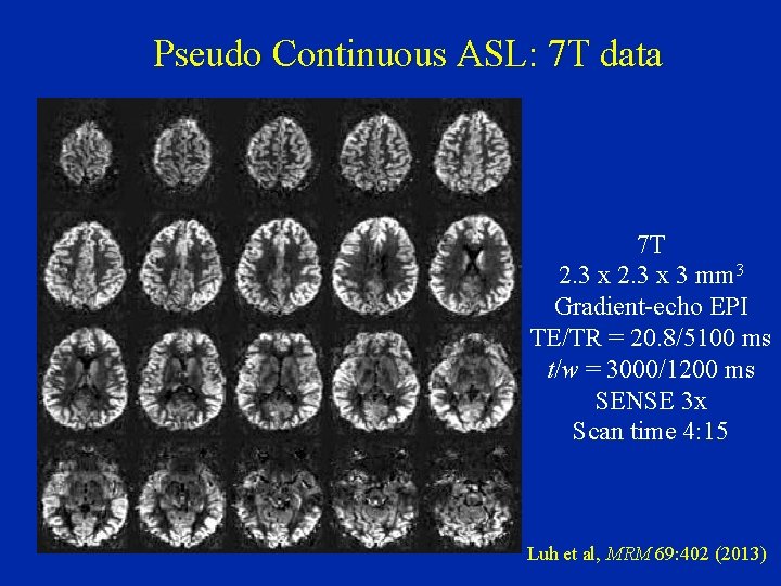 Pseudo Continuous ASL: 7 T data 7 T 2. 3 x 3 mm 3