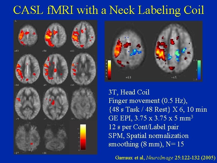 CASL f. MRI with a Neck Labeling Coil 3 T, Head Coil Finger movement
