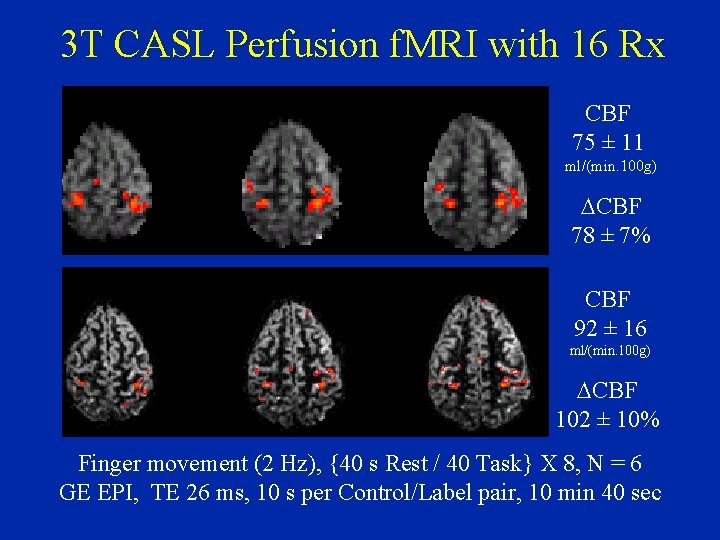 3 T CASL Perfusion f. MRI with 16 Rx 3 x 3 mm 3