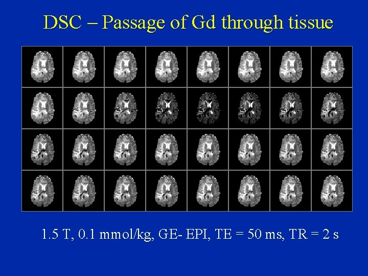 DSC – Passage of Gd through tissue 1. 5 T, 0. 1 mmol/kg, GE-