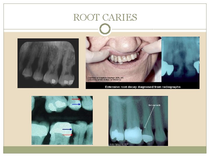 ROOT CARIES 