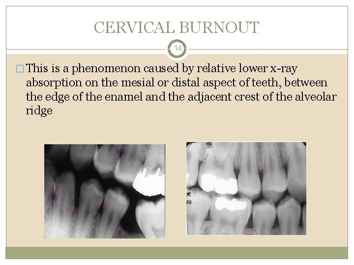 CERVICAL BURNOUT 14 � This is a phenomenon caused by relative lower x-ray absorption