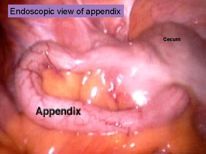 Endoscopic view of appendix Cecum 
