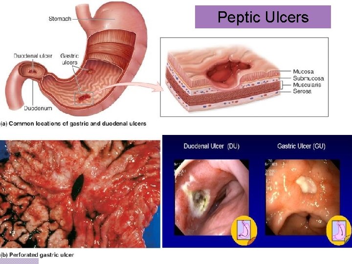 Peptic Ulcers 