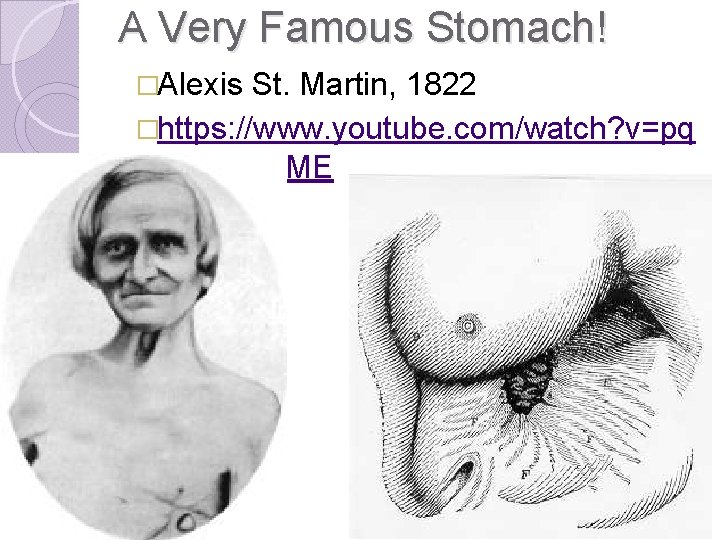 A Very Famous Stomach! �Alexis St. Martin, 1822 �https: //www. youtube. com/watch? v=pq gc.