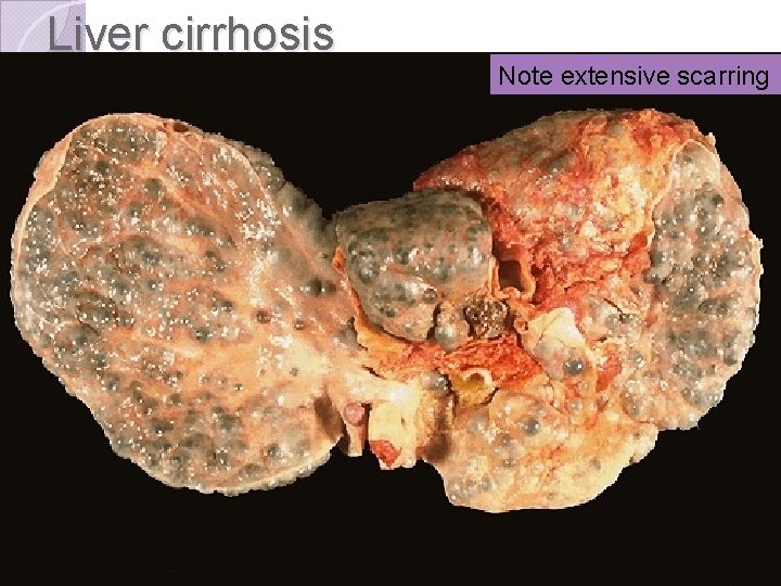 Liver cirrhosis Note extensive scarring 
