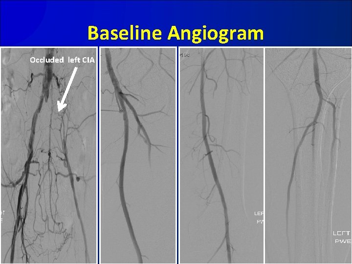 Baseline Angiogram Occluded left CIA 