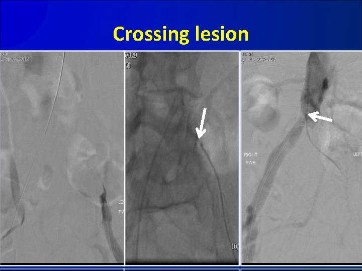 Crossing lesion 