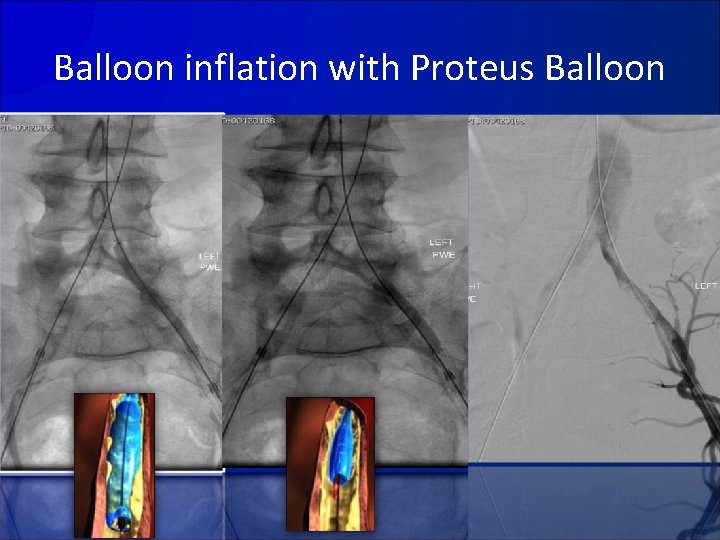 Balloon inflation with Proteus Balloon 