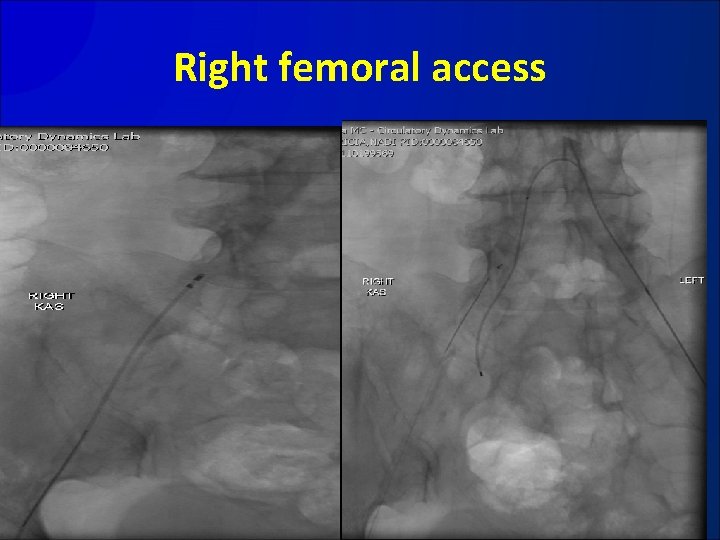 Right femoral access 