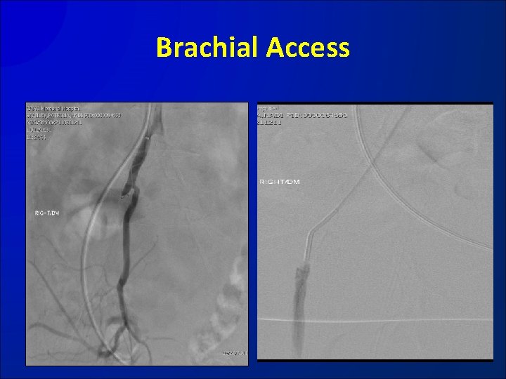 Brachial Access 