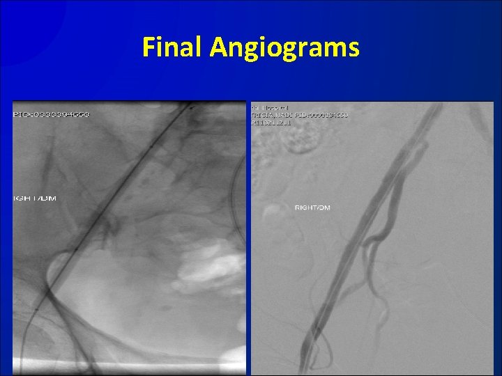 Final Angiograms 