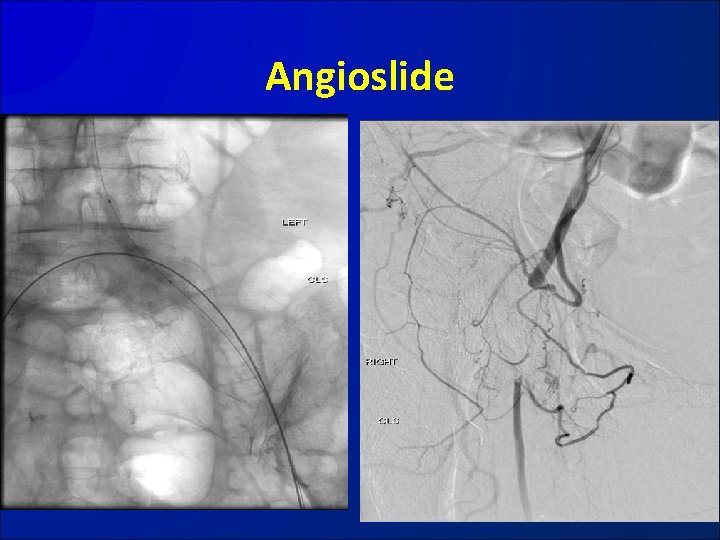 Angioslide 