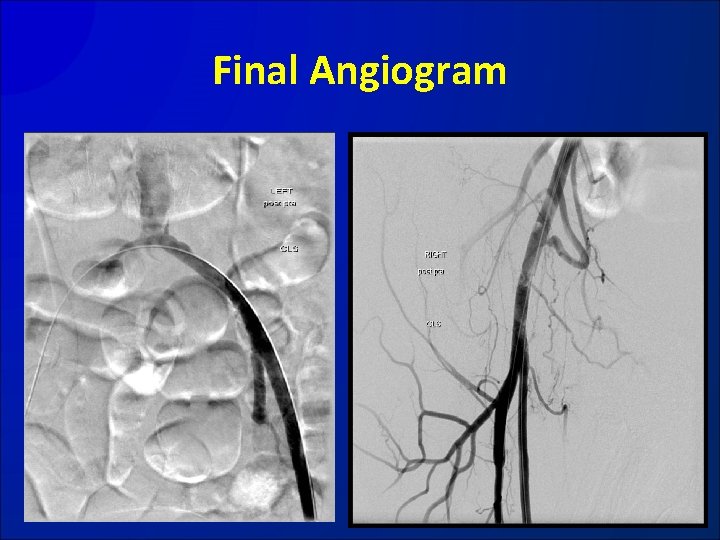 Final Angiogram 