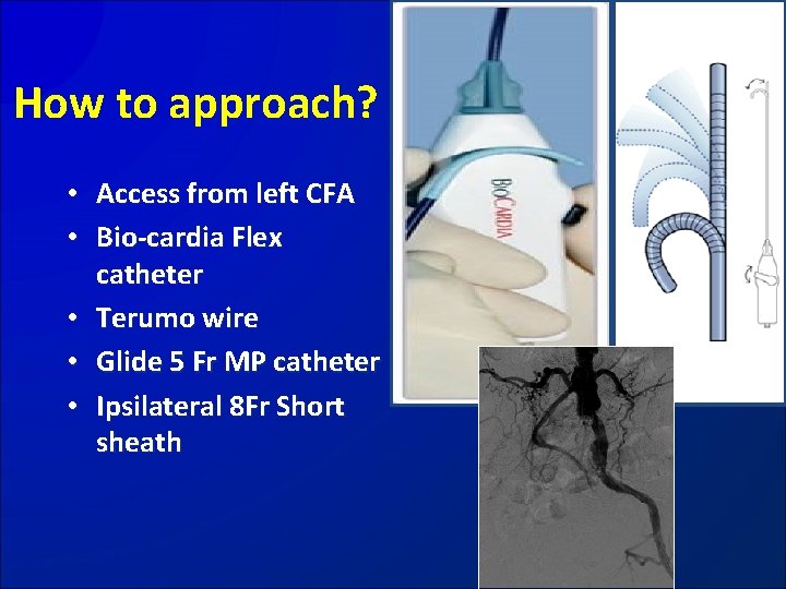 How to approach? • Access from left CFA • Bio-cardia Flex catheter • Terumo