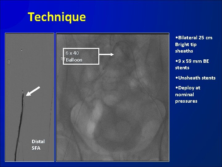 Technique 6 x 40 Balloon • Bilateral 25 cm Bright tip sheaths • 9