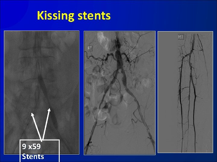 Kissing stents 9 x 59 Stents 