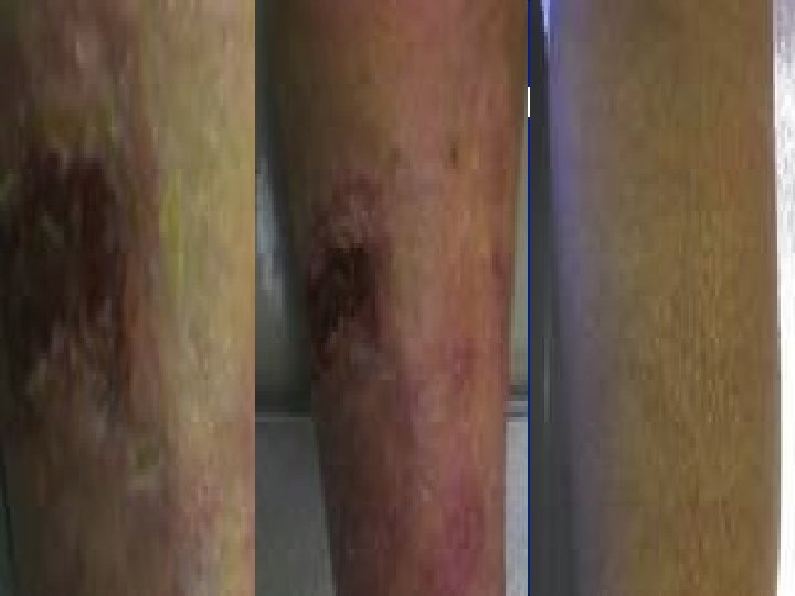 Leg ulcer before and after 