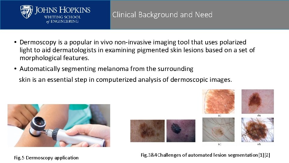 Clinical Background and Need • Dermoscopy is a popular in vivo non-invasive imaging tool Clinical Background and Need • Dermoscopy is a popular in vivo non-invasive imaging tool