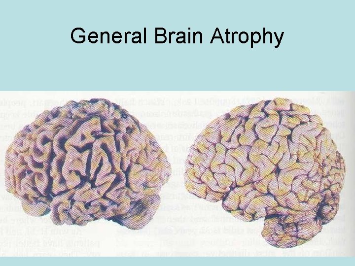 General Brain Atrophy 