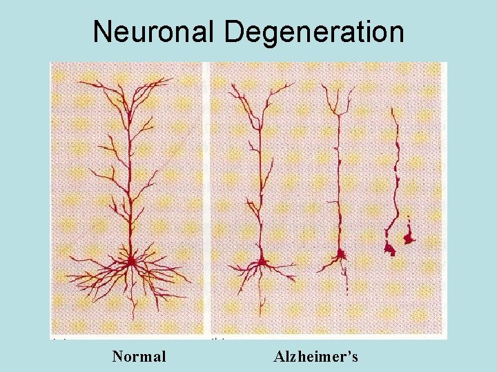 Neuronal Degeneration Normal Alzheimer’s 