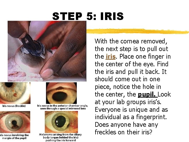 STEP 5: IRIS With the cornea removed, the next step is to pull out